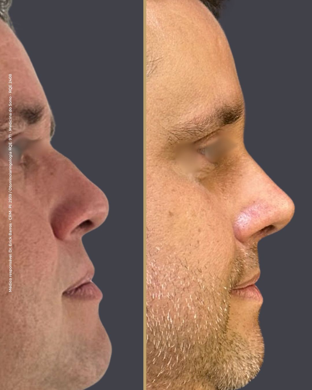 Antes e depois — caso clínico 11