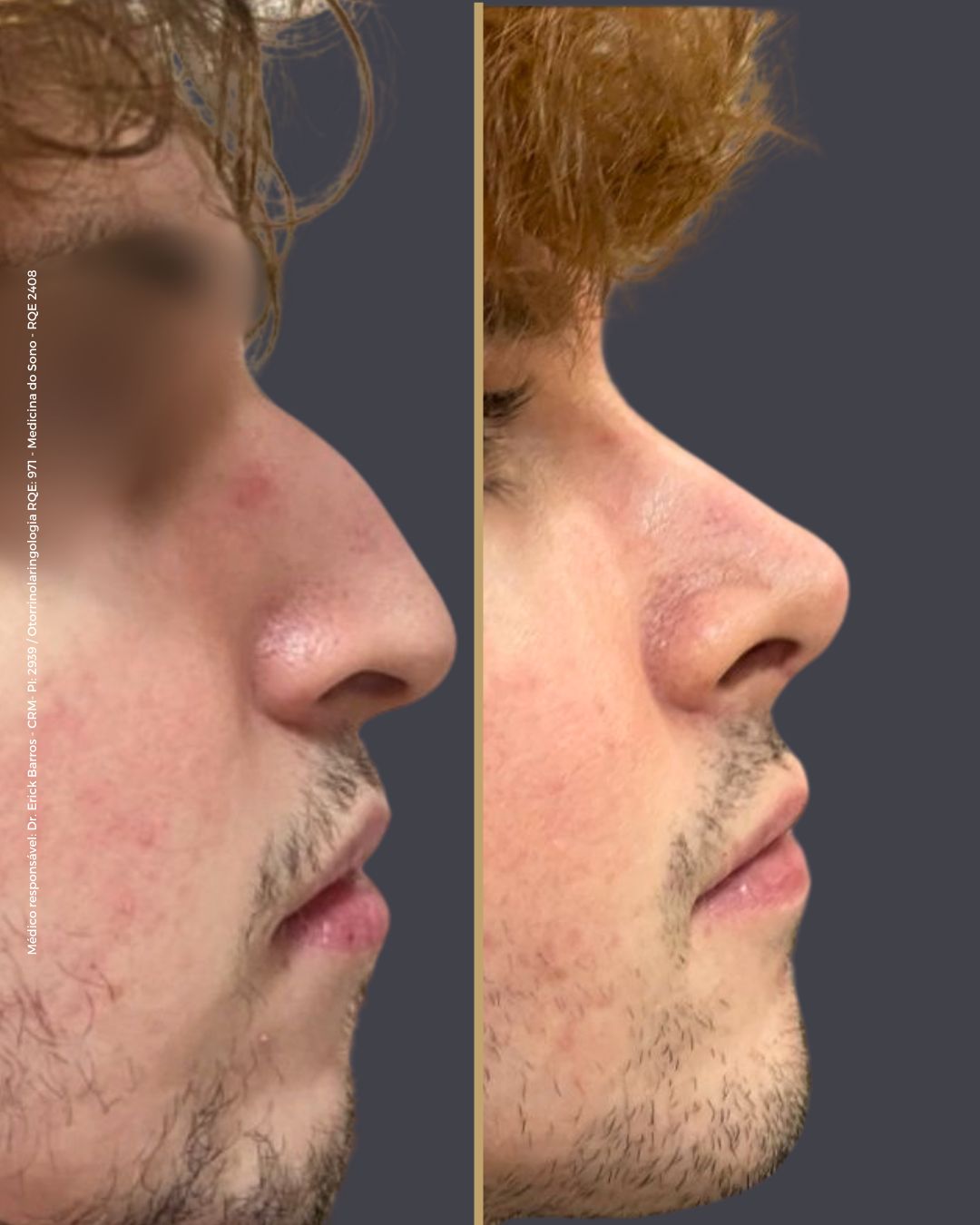 Antes e depois — caso clínico 15